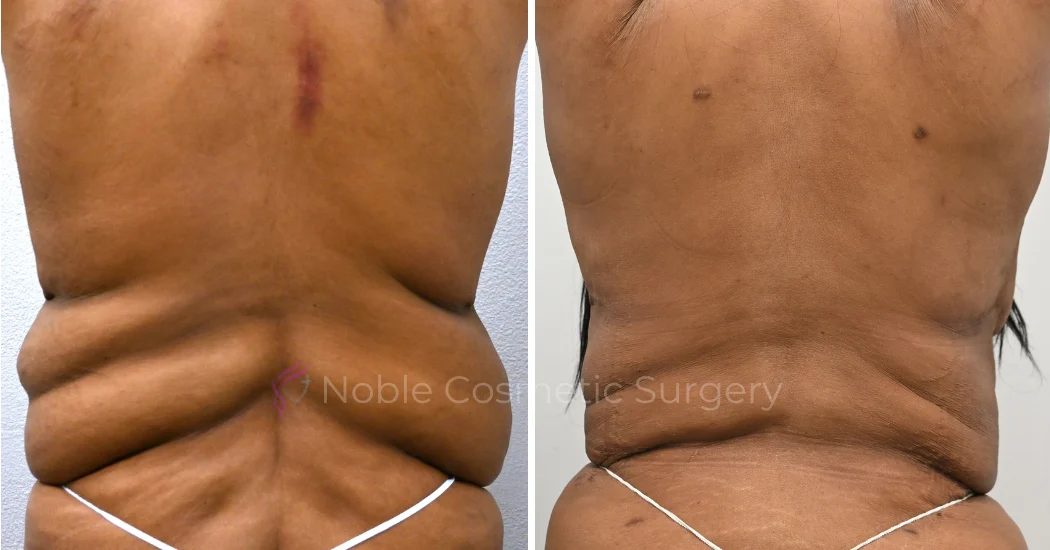 TUMMY-TUCK-CASE-00036 | Before and After Abdominoplasty 2