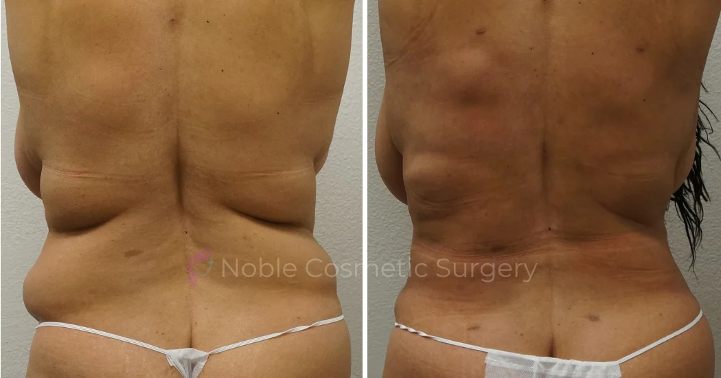 TUMMY-TUCK-CASE-00043 | Before and After Abdominoplasty 3