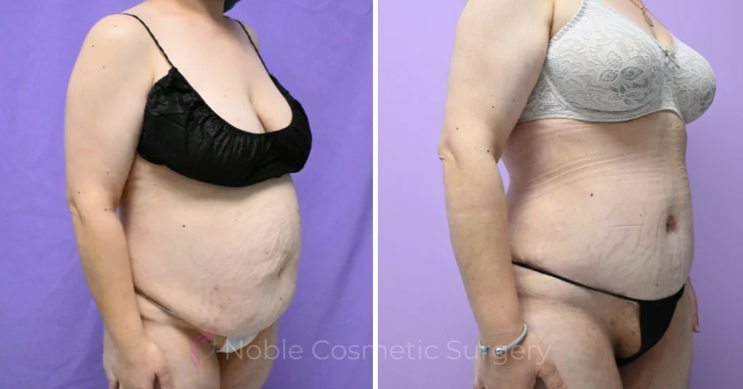 Case--19794 | Before and After Abdominoplasty 3