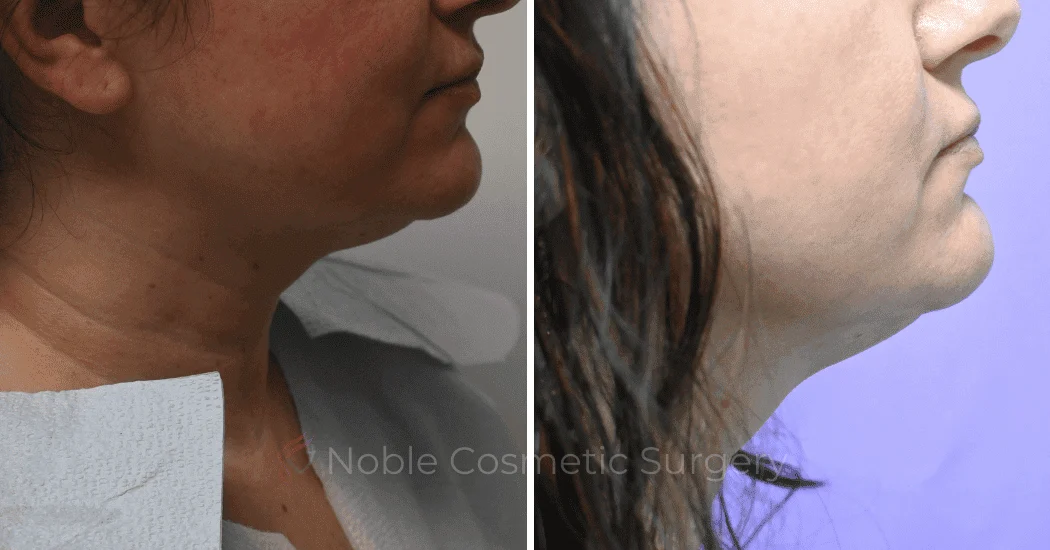 LIPOSUCTION-SUBMENTAL-19131 | Before and After Chin Liposuction 1