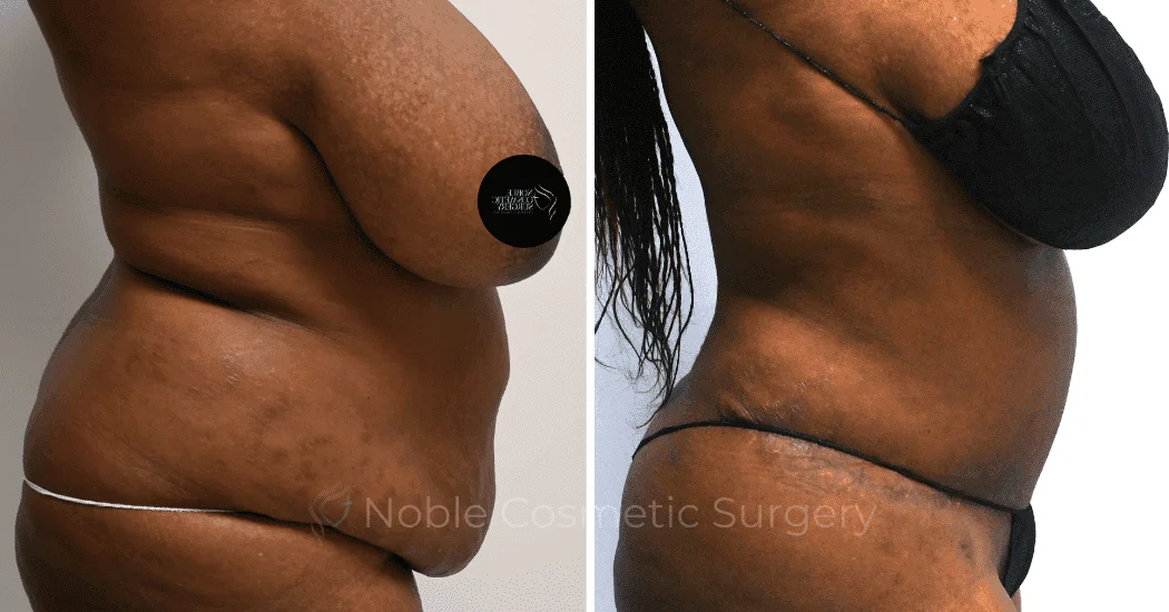 TUMMY-TUCK-CASE-11720 | Before and After Abdominoplasty 3