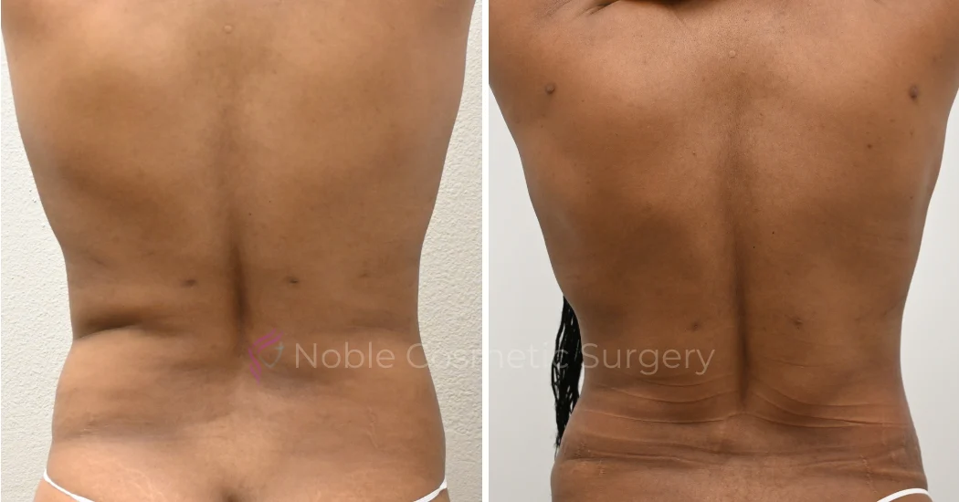 TUMMY-TUCK-CASE-00037 | Before and After Abdominoplasty 3