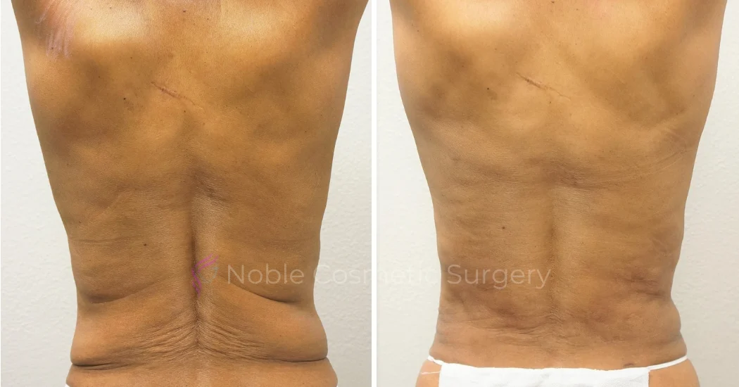 TUMMY-TUCK-CASE-00050 | Before and After Abdominoplasty 3