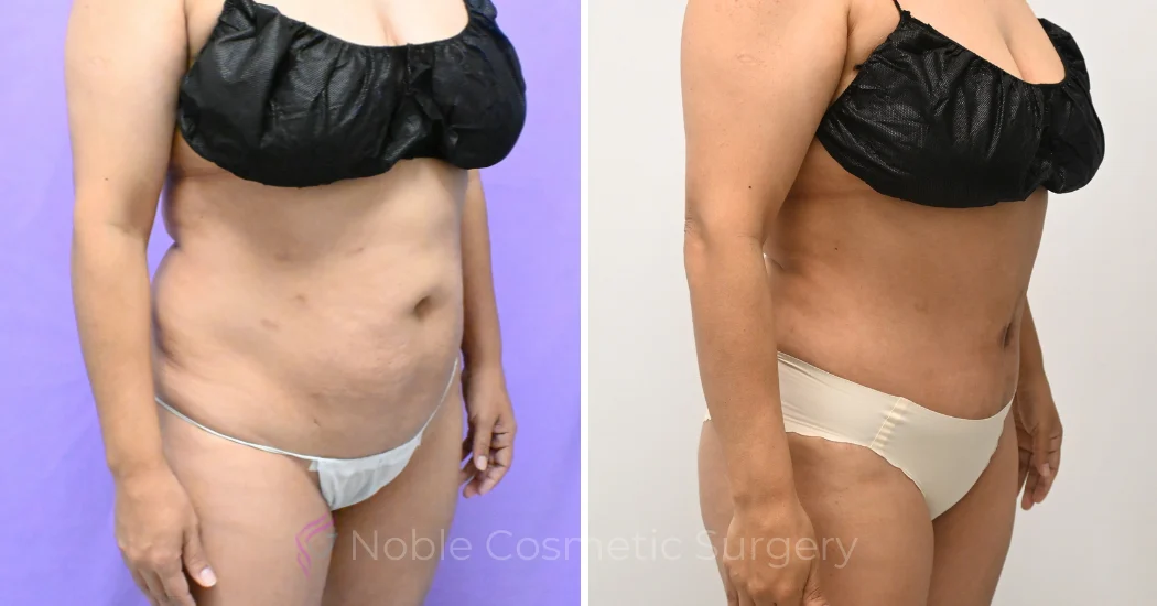 Case--20157 | Before and After Abdominoplasty 3