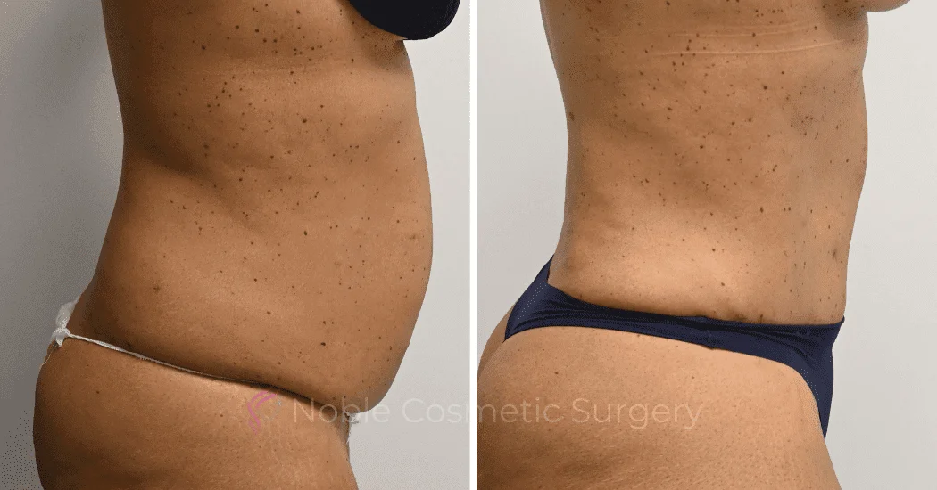TUMMY-TUCK-CASE-10616 | Before and After Abdominoplasty 3