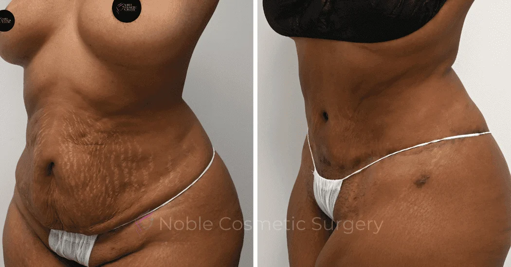 TUMMY-TUCK-CASE-14814 | Before and After Abdominoplasty 3