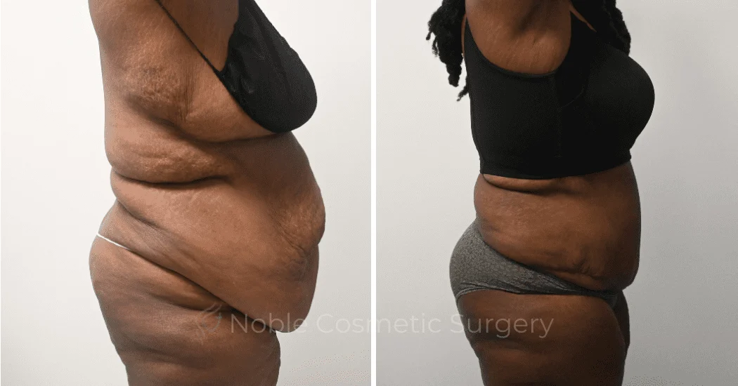 TUMMY-TUCK-CASE-00321 | Before and After Abdominoplasty 3
