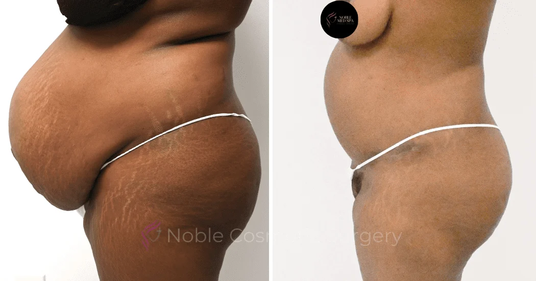 TUMMY-TUCK-CASE-11379 | Before and After Abdominoplasty 3