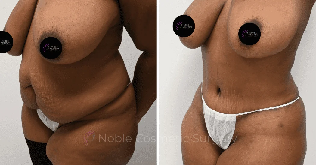 TUMMY-TUCK-CASE-14435 | Before and After Abdominoplasty 4