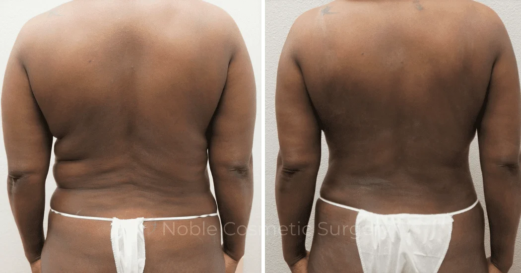 MOMMY-MAKEOVER-CASE-00305 | Before and After Mommy Makeover 3