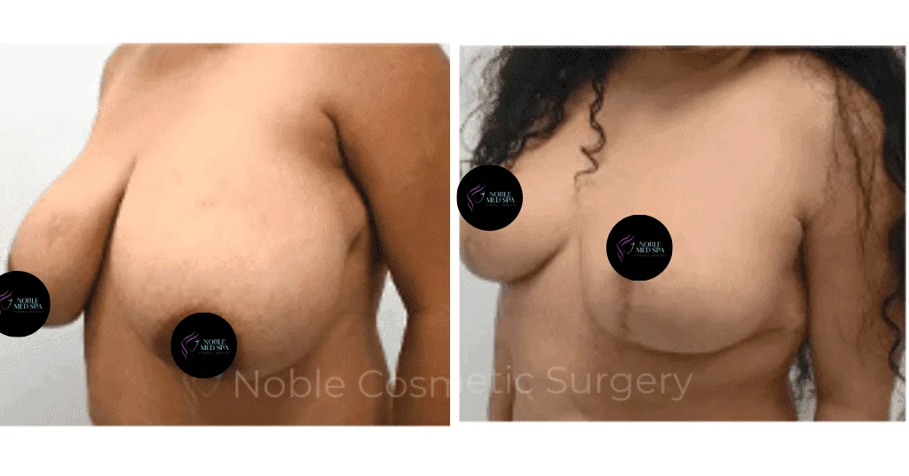 BREAST-REDUCTION-CASE-19221 | Before and After Breast Reduction 2