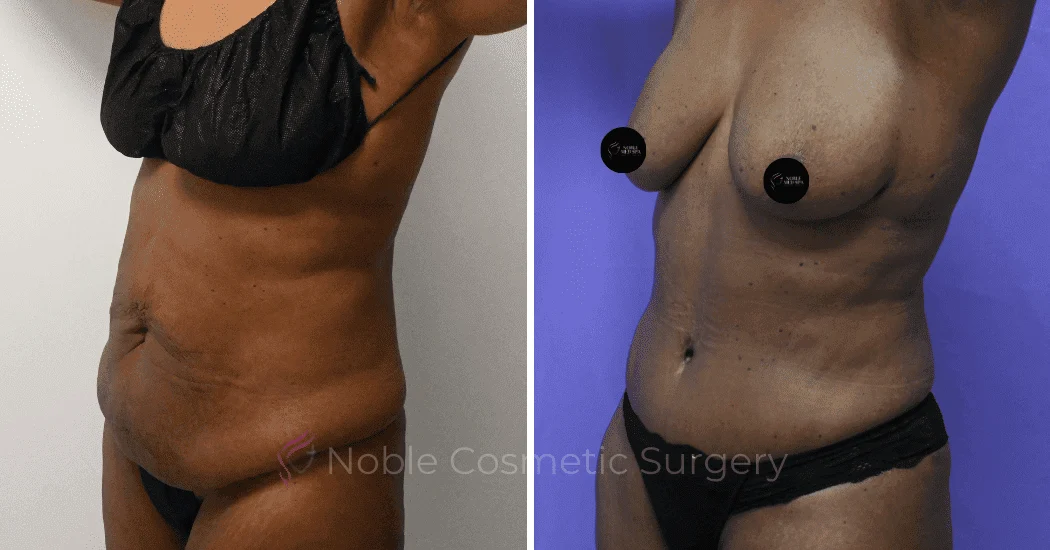 TUMMY-TUCK-CASE-10375 | Before and After Abdominoplasty 4