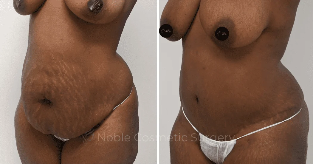TUMMY-TUCK-CASE-10563 | Before and After Abdominoplasty 4