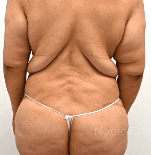 Before photo of a back lift patient in Plano, TX showing excess skin and tissue along the upper and lower back prior to body contouring surgery by Dr. Patrick C. Obasi.