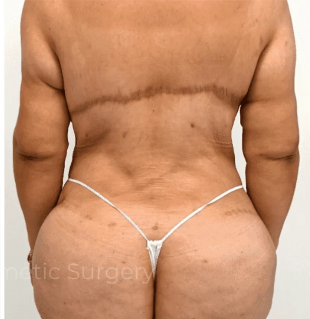 After photo of a back lift patient in Plano, TX showing smoother back contours, tighter skin, and improved body definition following surgery by Dr. Patrick C. Obasi.