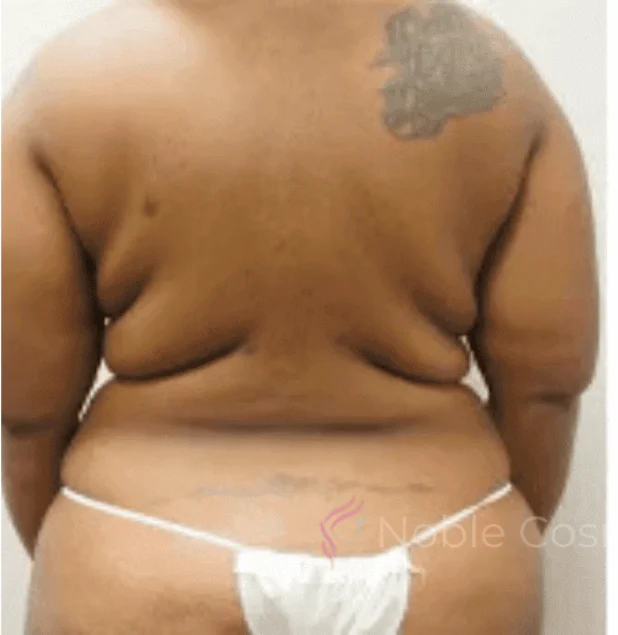 Before photo of a female patient prior to back lift surgery in Plano, TX showing excess back skin and soft tissue before contouring treatment by Dr. Patrick C. Obasi.