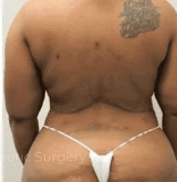 After photo of a female patient following back lift surgery in Plano, TX showing tighter skin, smoother contours, and improved back definition by Dr. Patrick C. Obasi.
