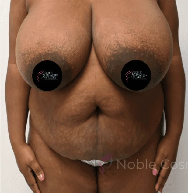 Before photo of a tummy tuck patient in Plano, TX showing excess abdominal skin, weakened muscles, and loose tissue prior to surgery by Dr. Patrick C. Obasi.