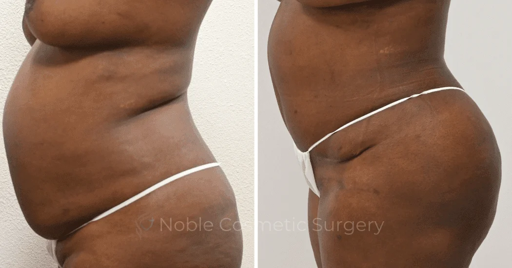 TUMMY-TUCK-CASE-13477 | Before and After Abdominoplasty 3