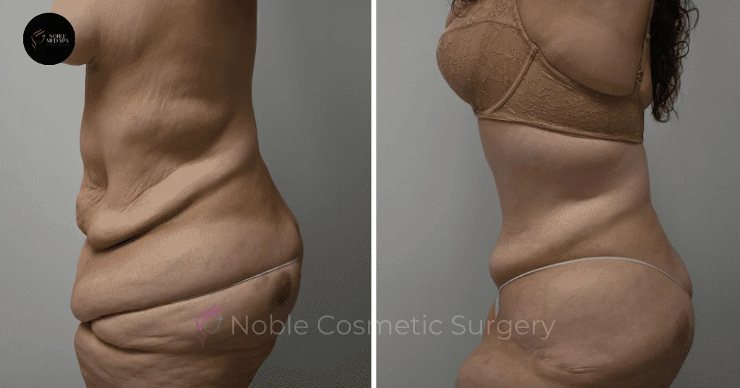 TUMMY-TUCK-CASE-10950 | Before and After Abdominoplasty 5