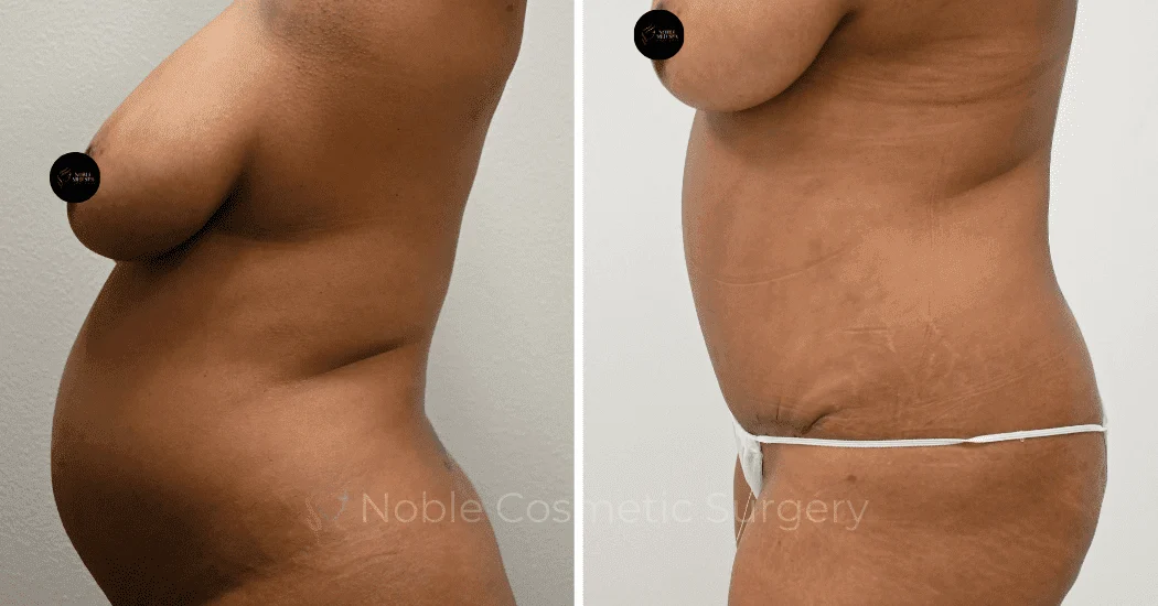 TUMMY-TUCK-CASE-14407 | Before and After Abdominoplasty 4