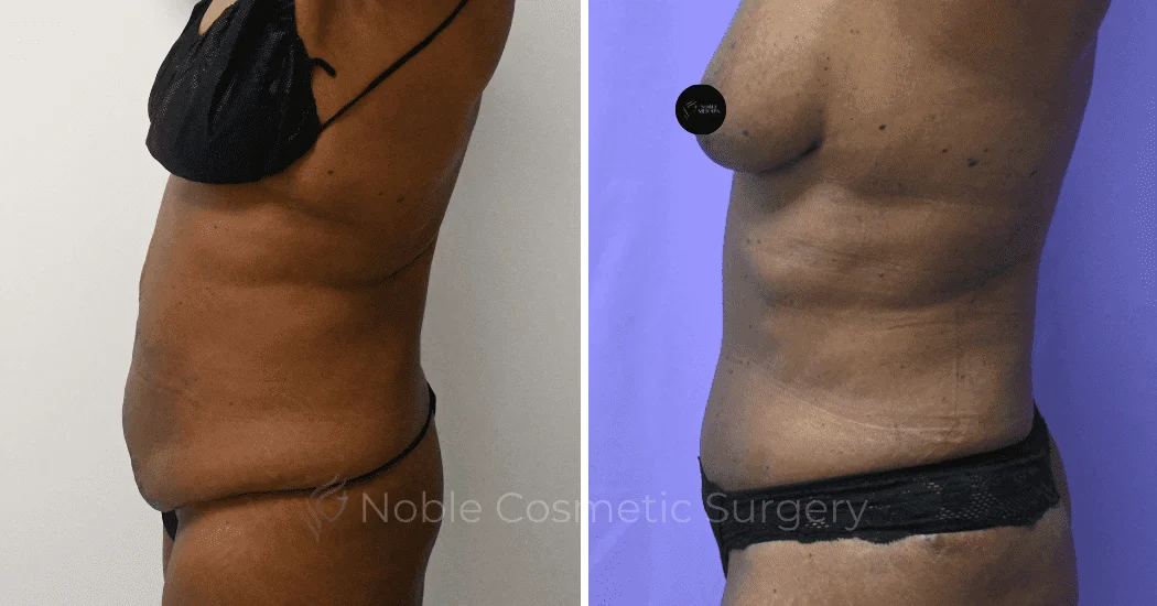 TUMMY-TUCK-CASE-10375 | Before and After Abdominoplasty 5