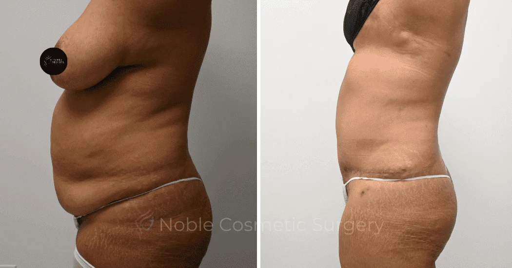 TUMMY-TUCK-CASE-11110 | Before and After Abdominoplasty 5