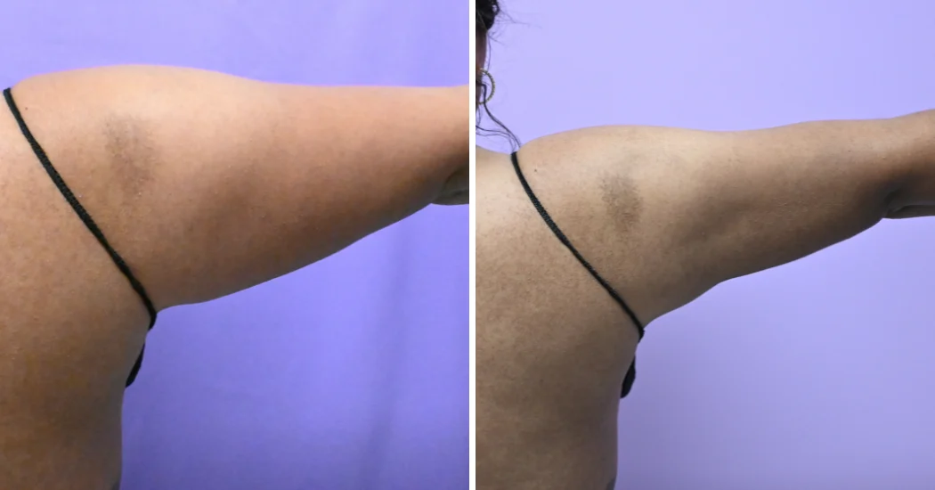 Case--20274 | Before and After Arm Liposuction 1