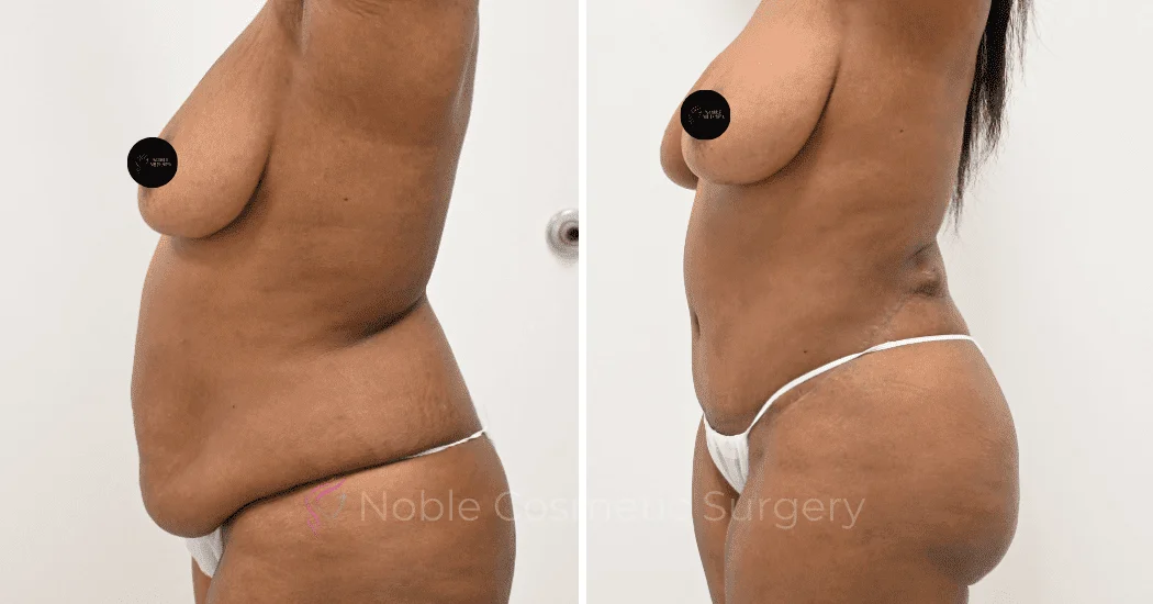 TUMMY-TUCK-CASE-13171 | Before and After Abdominoplasty 5