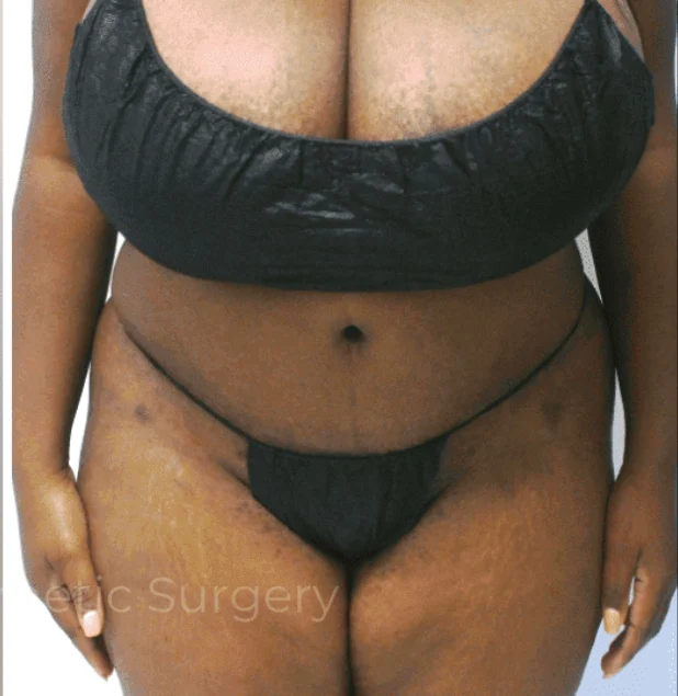 After photo of a tummy tuck patient in Plano, TX showing a flatter abdomen, tighter contours, and improved waistline definition following surgery by Dr. Patrick C. Obasi.
