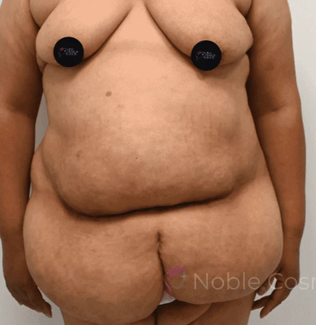 Before photo of a female patient prior to tummy tuck surgery in Plano, TX showing abdominal skin laxity and excess tissue before body contouring by Dr. Patrick C. Obasi.