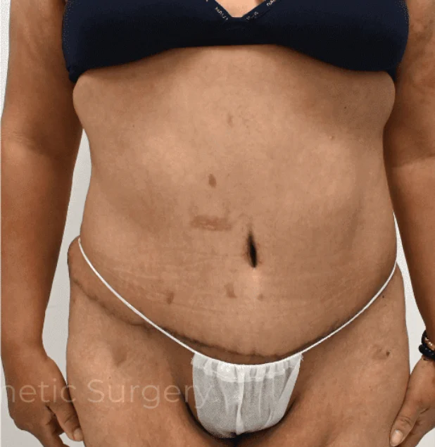 After photo of a female patient following tummy tuck surgery in Plano, TX showing a tighter abdomen, smoother skin, and enhanced waistline contour by Dr. Patrick C. Obasi.