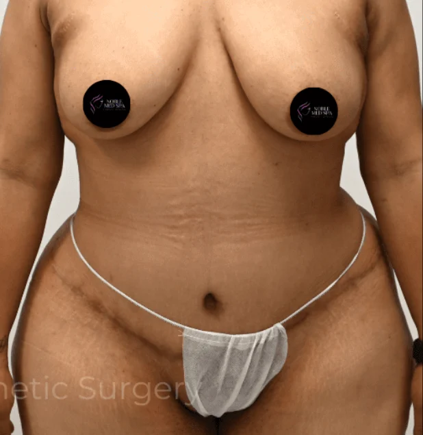 After photo of a tummy tuck patient in Plano, TX showing a flatter stomach, tighter abdominal contours, and smoother skin following surgery by Dr. Patrick C. Obasi.