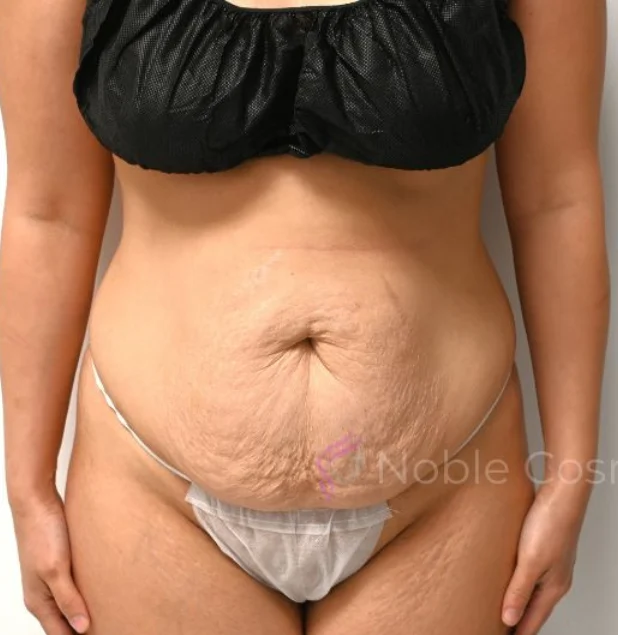 Before photo of a female patient before tummy tuck surgery in Plano, TX showing abdominal skin laxity and excess tissue prior to contouring surgery by Dr. Patrick C. Obasi.