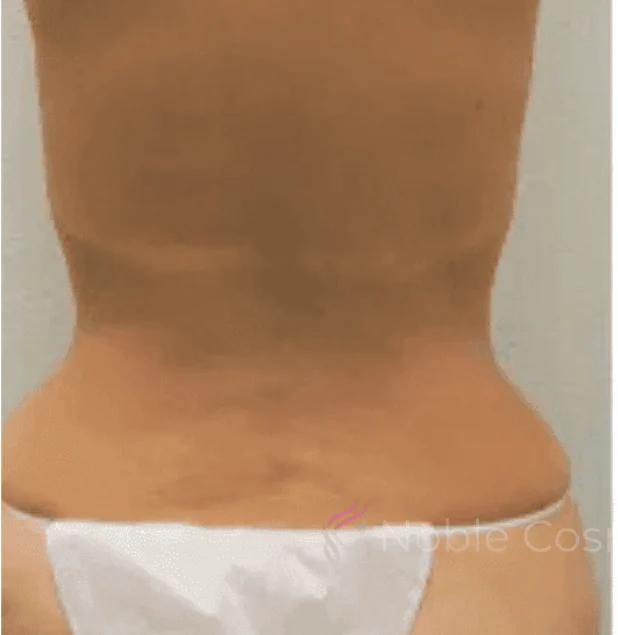 Before photo of a buttock lift patient in Plano, TX showing skin laxity and loss of contour in the buttocks prior to body contouring surgery by Dr. Patrick C. Obasi.