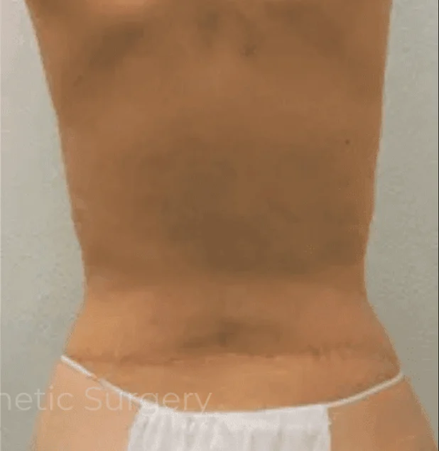 After photo of a buttock lift patient in Plano, TX showing improved contour, lifted appearance, and smoother skin following surgery by Dr. Patrick C. Obasi.
