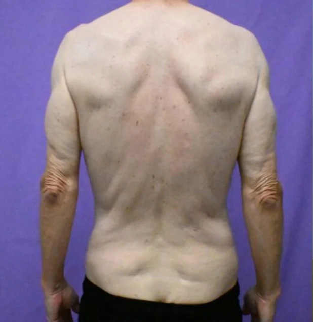 Before photo of a male patient prior to buttock lift surgery in Plano, TX showing skin laxity and loss of contour before body contouring treatment by Dr. Patrick C. Obasi.