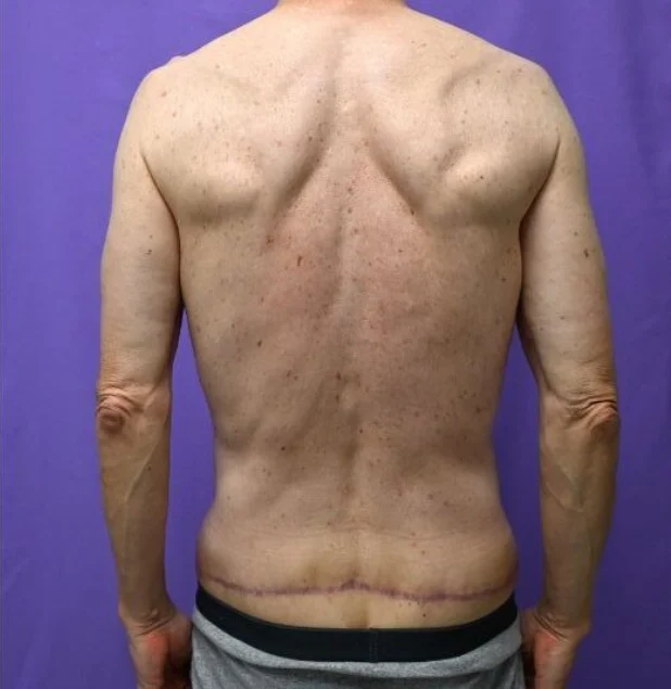 After photo of a male patient following buttock lift surgery in Plano, TX showing improved contour, firmer appearance, and smoother skin by Dr. Patrick C. Obasi.
