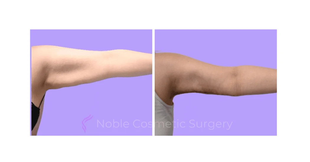 ARM-LIFT-CASE-19182 | Before and After Brachioplasty 1