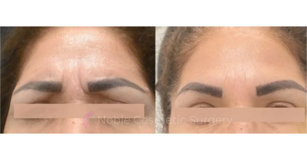 BOTOX-CASE-10011 | Before and After BOTOX® Cosmetic 1