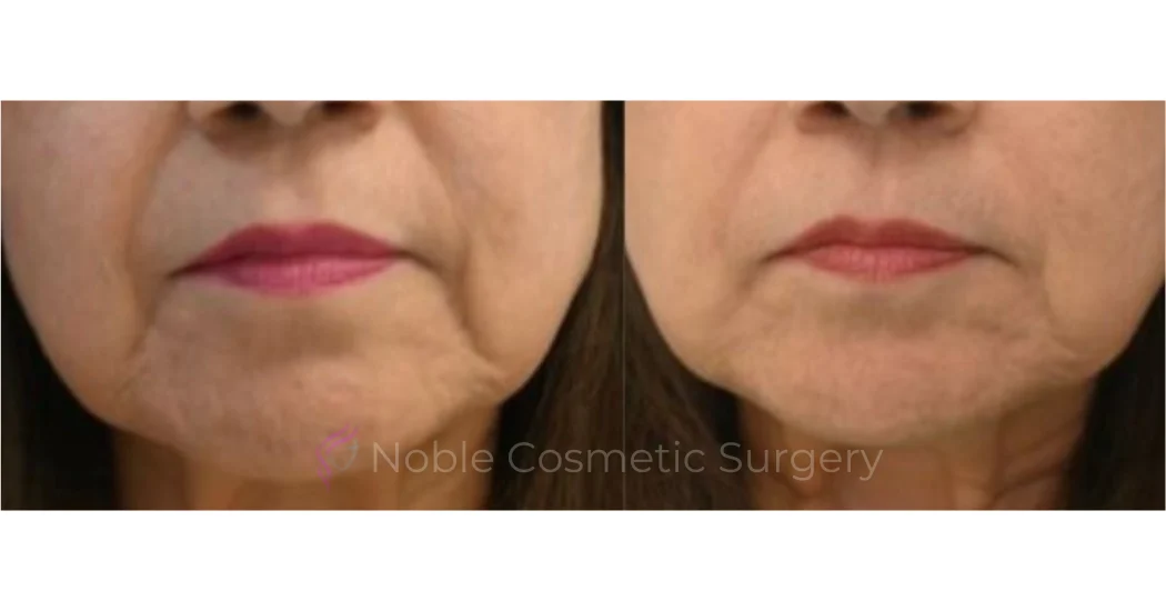 BOTOX-CASE-10012 | Before and After BOTOX® Cosmetic 1