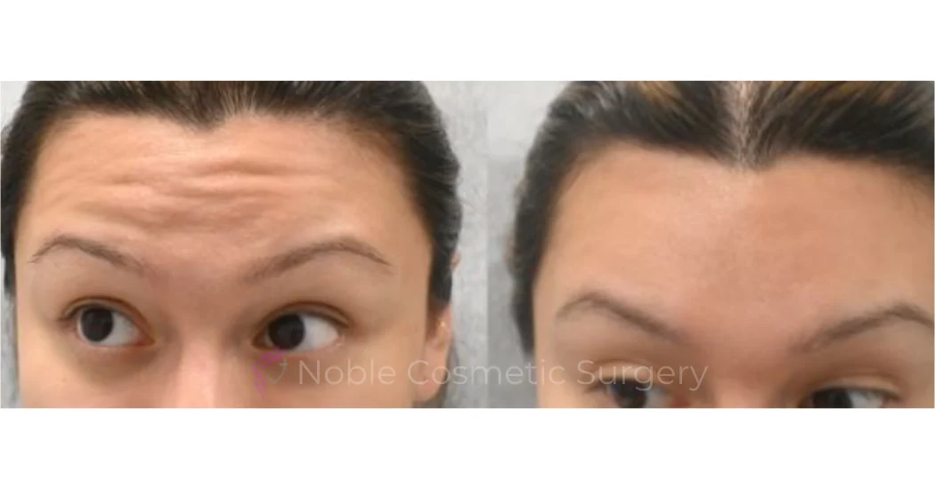 BOTOX-CASE-10013 | Before and After BOTOX® Cosmetic 1