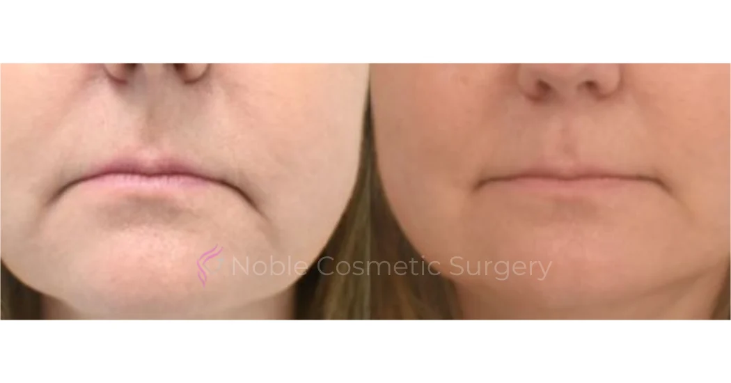 BOTOX-CASE-10015 | Before and After BOTOX® Cosmetic 1
