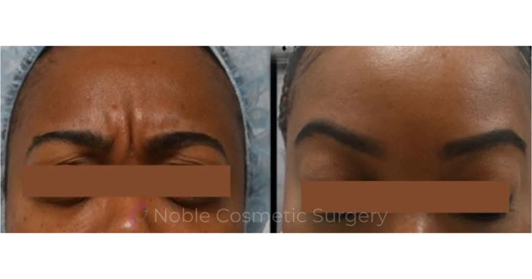 BOTOX-CASE-10016 | Before and After BOTOX® Cosmetic 1
