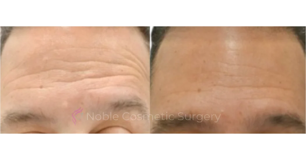 BOTOX-CASE-10018 | Before and After BOTOX® Cosmetic 1