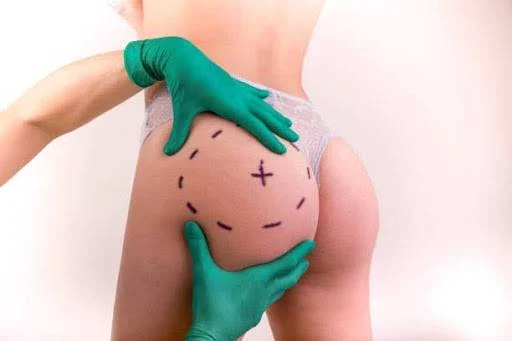 Thinking About a Brazilian Butt Lift? Find Out If You’re the Perfect Candidate