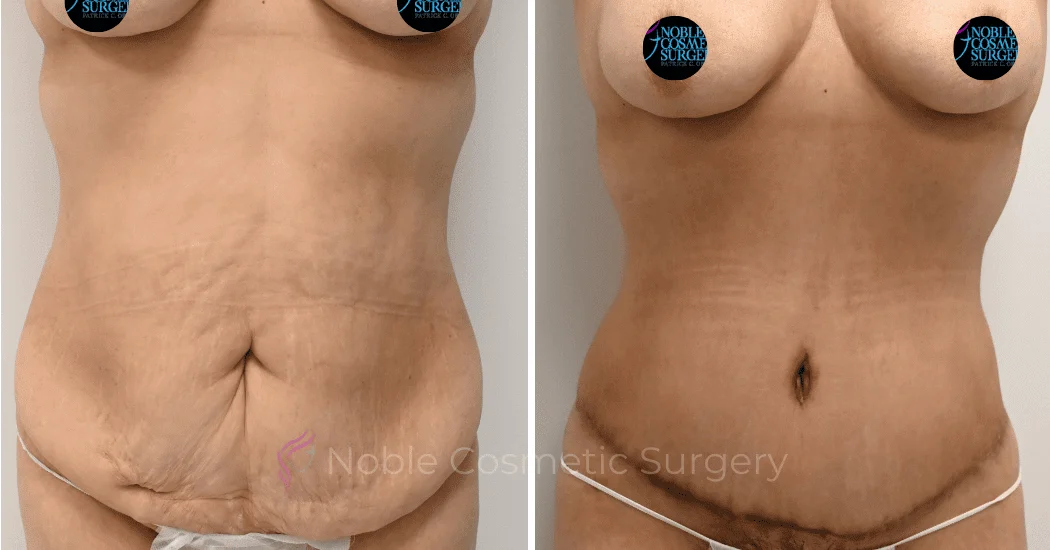 TUMMY-TUCK-CASE-00317 | Before and After Abdominoplasty 1