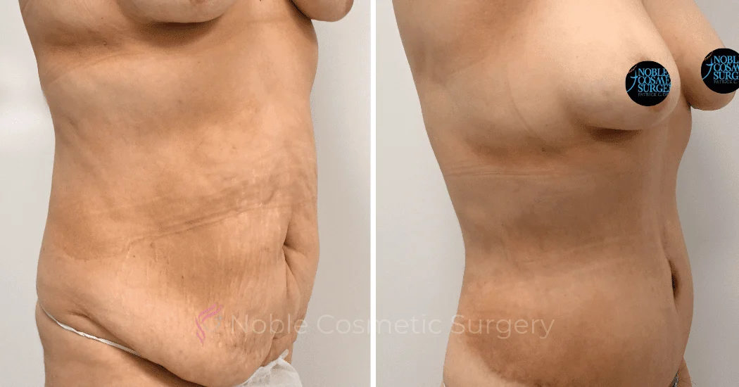 TUMMY-TUCK-CASE-00317 | Before and After Abdominoplasty 2