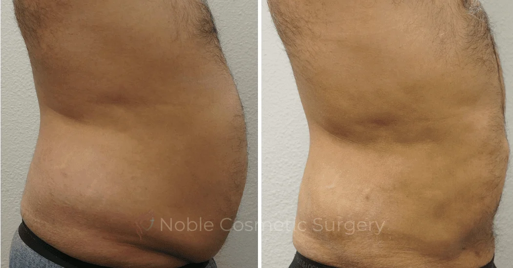 LIPOSUCTION-ABDOMEN-CASE-00600 | Before and After Male Liposuction 1