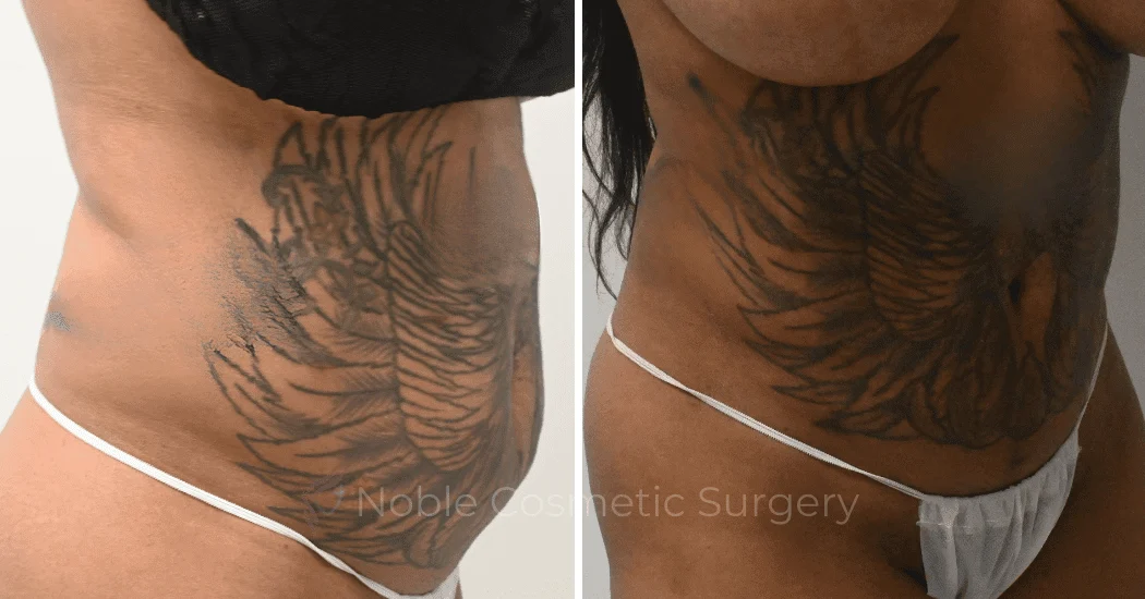 LIPOSUCTION-CASE-10243 | Before and After Liposuction 1